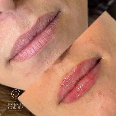 Fotos del relleno de labios con ácido hialurónico antes y después